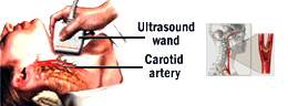 Stroke / Carotid Artery