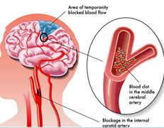 Stroke / Carotid Artery Disease