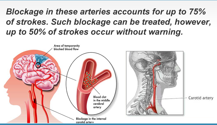 Stroke / Carotid Artery Disease