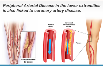 Peripheral Arterial Disease