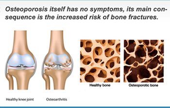 Osteoporosis Screening