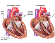 Atrial Fibrillation Heart Rhythm