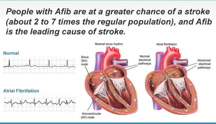 Atrial Fibrillation Heart Rhythm