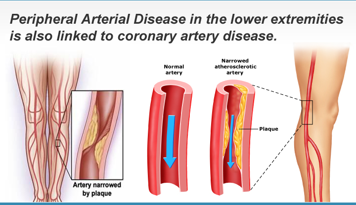 Peripheral Arterial Disease in the lower extremities is also linked to...